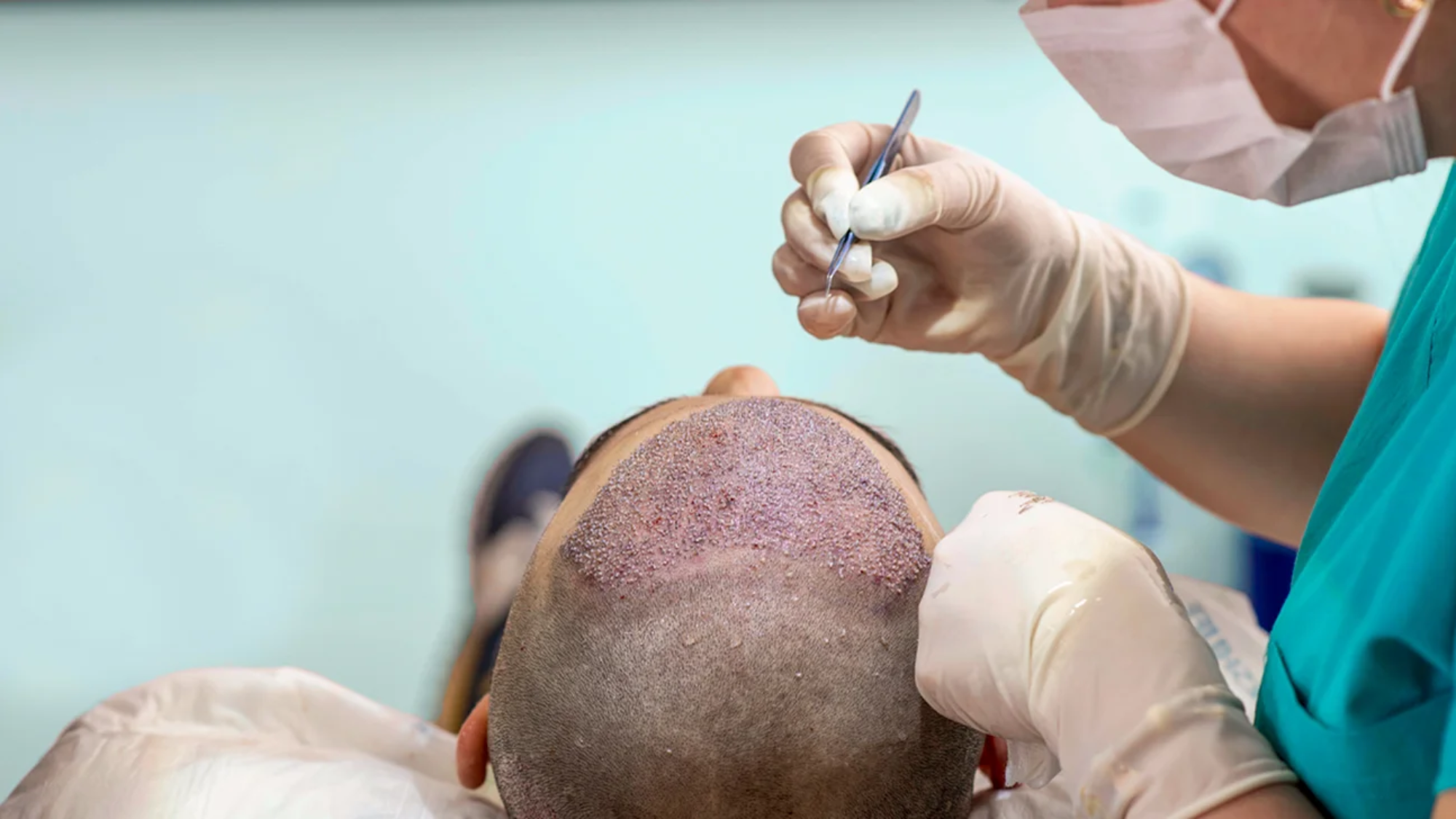 FUE Hair Transplant